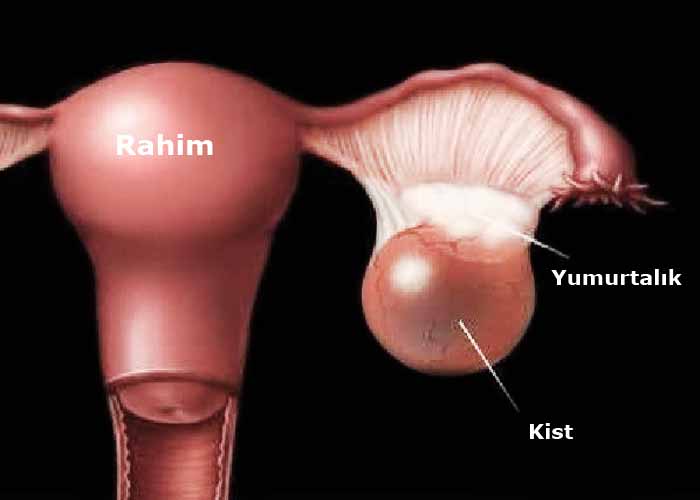 yumurtalik-over-kisti