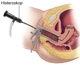 histeroskopi